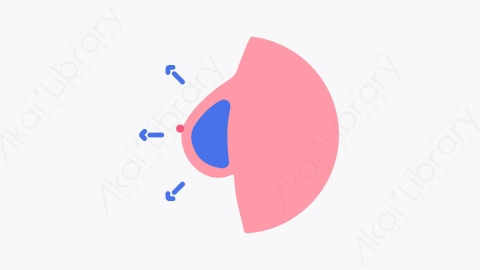 图片素材-006乳房植入物 breast implant扁平MG卡通整容手术元素图标
